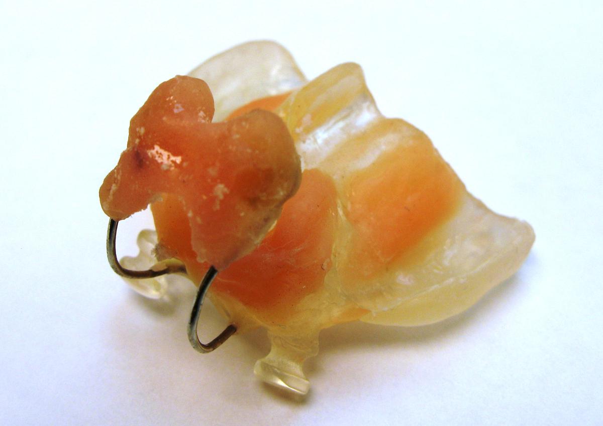 Nasoalveolar Molding NAM for Cleft Palate St. Louis Children's Hospital